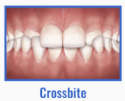 cross_bite